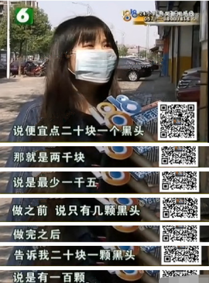 1个黑头20元